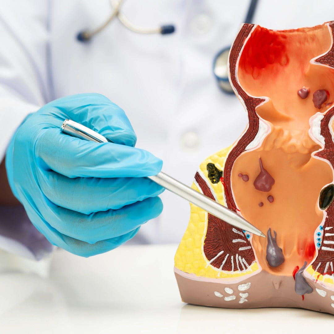 Hämorrhoiden Behandlung OP Erfahrung